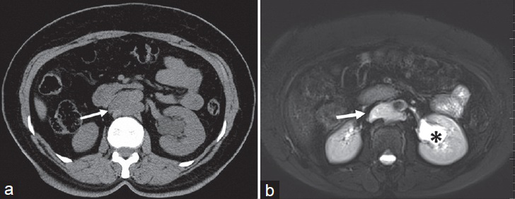 25-year-old woman diagnosed with lymphangioma. (a) Axial CT, (b) axial T2W fat-suppressed images show a well-defined cystic mass in the retroaortic region (arrows). There is also parapelvic cyst in the left kidney (asterisk). Note that due to chylous content, T2 signal intensity is slightly decreased with respect to the left kidney cyst (b).