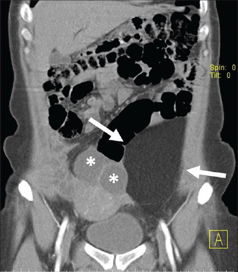 43-year-old woman diagnosed with lipoma. Post-contrast CT image shows a well-circumscribed solid mass lesion with homogeneous fat attenuation, in contact with the left external iliac artery. The solid lesion causes displacement of left ovary and uterus due to the mass effect. Note that no thick, irregular, or nodular septa are seen in contrast-enhanced images (arrows). There are also medially displaced cysts originating from the left ovary (asterisks).