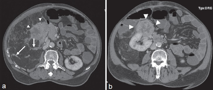 54-year-old man diagnosed with angiomyolipoma. (a and b) Post-contrast axial CT images demonstate a gross right pararenal mass lesion containing adipose tissue compatible with angiomyolipoma. Heterogeneous enhancing septa and high attenuation areas are seen (arrows). Note that there is also a hypervascular soft-tissue component originating from the anterior portion of the right kidney, which helps in ruling out a perirenal liposarcoma (arrowheads).