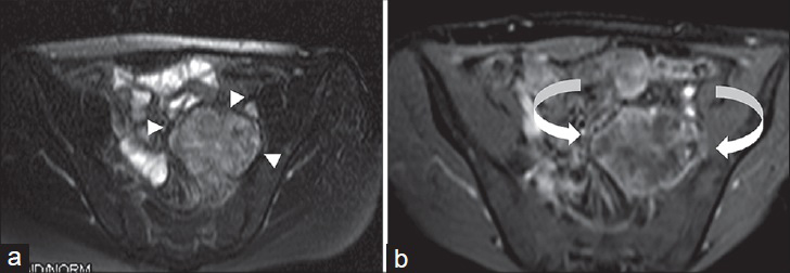 24-year-old man dignosed with left pelvic schwannoma. (a) Axial T2W fat-suppressed and (b) post-contrast fat-suppressed T1W images show a heterogeneously hyperintense area in T2W image due to microcytic spaces (arrowheads). Peripheral contrast enhancement is observed in post-contrast T1W image (curved arrows).