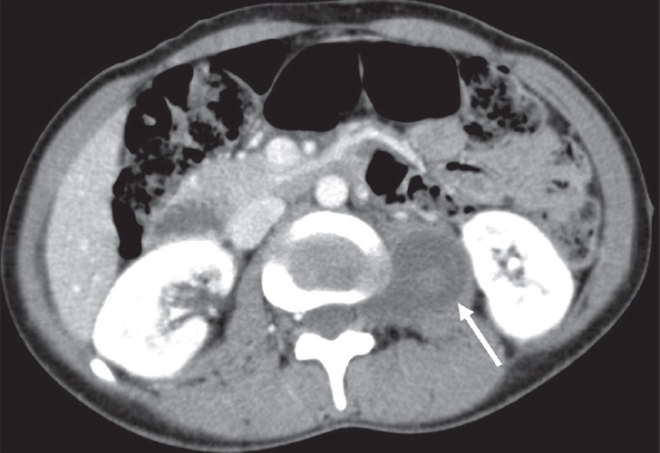 28-year-old man with neurofibroma. Axial post-contrast CT image shows a hypoattenuating neurofibroma in the left psoas muscle. Note that left neural foraminal extension is helpful in diagnosis (arrow).