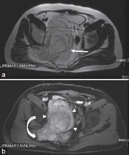 73-year-old man with known history of type 1 neurofibromatosis. (a) Axial T2W and (b) T1W fat-suppressed post-contrast images show retroperitoneally located plexiform neurofibroma in the pelvis. Lesion is hyperintense with respect to muscle in T2W image (arrow). Avid contrast enhancement is seen in post-contrast series (arrowheads). Note that plexiform neurofibroma passes through the piriform foramen within the trace of sciatic nerve and gives a dumbbell appearance (curved arrow).