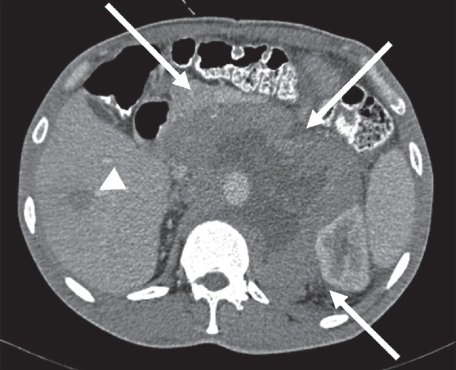 42-year-old man diagnosed with malignant paraganglioma. Axial post-contrast CT image demonstrates malignant paraganglioma encircling abdominal aorta in the retroperitoneal region with peripheral enhancement (arrows). Due to extensive necrosis, central portion of the tumor is hypodense with regard to peripheral areas. Note that there is also a liver metastasis (arrowhead) revealing systemic spread.