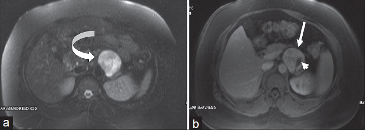 39-year-old woman with retroperitoneal paraganglioma. (a) Axial T2W fat-suppressed and (b) post-contrast T1W fat-suppressed images show a left retroperitoneal paraganglioma close to pancreatic corpus. Highly hyperintense appearance is seen in T2W image (curved arrow). Avid contrast enhancement is seen in post-contrast T1W image (arrow). Note that due to vascular structure, a signal void is seen in post-contrast image (arrowhead).