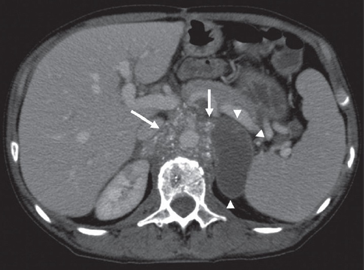 64-year-old man diagnosed with extragonadal germ cell tumor. Axial post-contrast CT image of the extragonadal germ cell tumor shows a solid mass encircling aorta with speckled calcification in the para-aortic region (arrows). Tumoral mass lesion contains cystic portion (arrowheads).