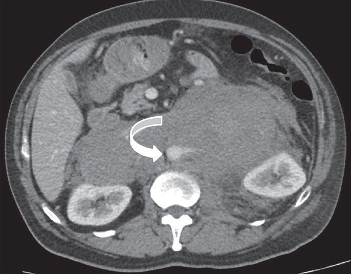 37-year-old man diagnosed with non-Hodgkin lymphoma. Axial post-contrast CT image shows a mildly enhancing solid mass surrounding abdominal aorta, giving “CT angiogram” sign (curved arrow).