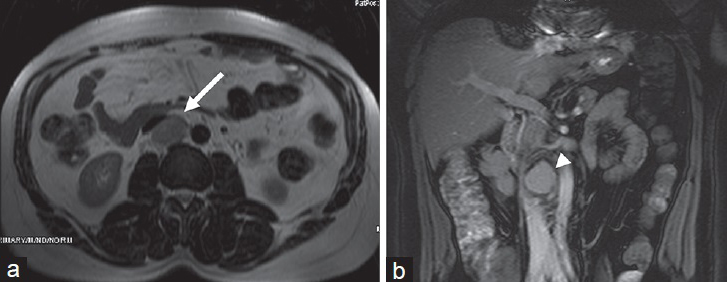 53-year-old man with hyaline type Castleman disease. (a) T2W image shows mass lesion is slightly hypointense with regard to fat tissue (arrow). (b) T1W coronal fat-supressed image shows homogeneous contrast enhancement (arrowhead).