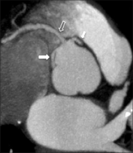 56-year-old male patient admitted with chest pain diagnosed with three coronary arteries originating separately from the right coronary sinus. Axial oblique maximum intensity projection image shows left anterior descending artery (short white arrow), right coronary artery (open arrow), and left circumflex artery (long white arrow) – three coronary arteries originating from the right coronary sinus.