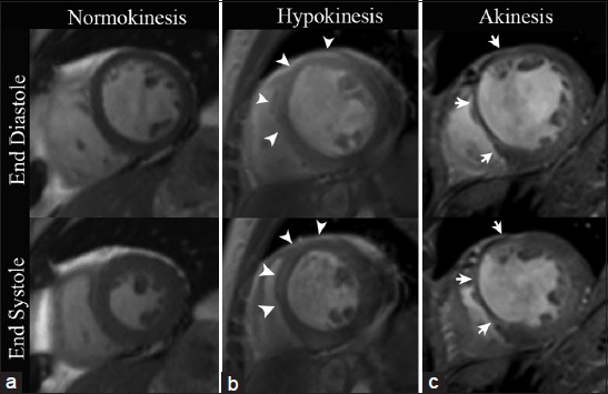 CMRI SSFP with mid-ventricle short axis views in three different patients. (a) 58-year-old healthy female demonstrates a uniform increase in myocardial wall thickness greater than 30% during systole. (b) 46-year-old male with a previous infarct in the left anterior descending (LAD) coronary artery distribution displays less than 30% of systolic myocardial wall thickening in the mid-anterior and anteroseptal wall (arrowheads), exemplifying hypokinesis. (c) 68-year-old female with a remote myocardial infarction in the LAD coronary artery territory shows less than 10% systolic increase in myocardial wall thickening in the anterior and anteroseptal wall illustrating a case of focal akinesis (arrows).