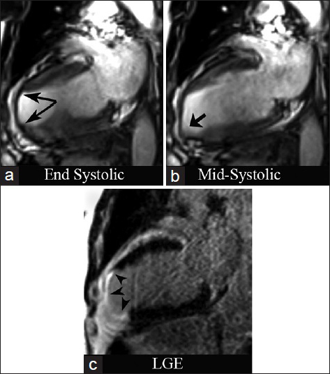 74-year-old male with stable angina diagnosed with chronic ischemic cardiomyopathy and LV aneurysm. CMRI with two-chamber views. SSFP at end systole (a) demonstrates severe LV wall thinning in the apex and apical anterior wall (long arrows). (b) Mid-systolic apical bulging (short arrow). (c) Inversion recovery delayed enhancement (DEIR) imaging demonstrates transmural enhancement of the apex, apical anterior, and apical inferior wall (arrowheads), matching the regions of myocardial wall thinning and dyskinesis.