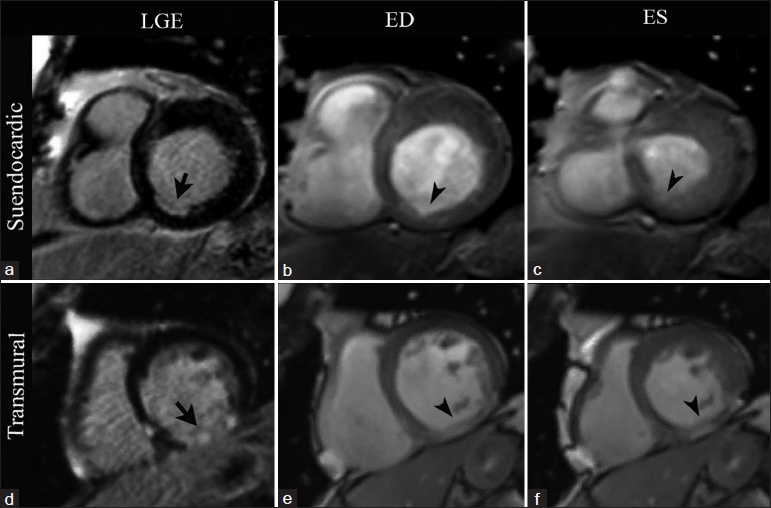 CMRI short-axis views at the level of the cardiac base in two different patients. First row: 72-year-old patient with stable chronic ischemic cardiomyopathy. LGE imaging (a) demonstrates subendocardial enhancement involving less than 50% of the wall thickness in the basal inferoseptal wall (arrow). SSFP imaging at end diastole (b) and end systole (c) show an area of hypokinesis matching the area of abnormal enhancement (arrowheads). Second row: 61-year-old patient with history of a remote infarct in the right coronary artery distribution. LGE imaging (d) demonstrates a pattern of transmural LGE involving nearly 100% of the myocardium in the basal inferior wall (arrow). A focal area of akinesis matching the region of transmural LGE is seen with SSFP imaging at end diastole (e) and end systole (f) (arrowheads).
