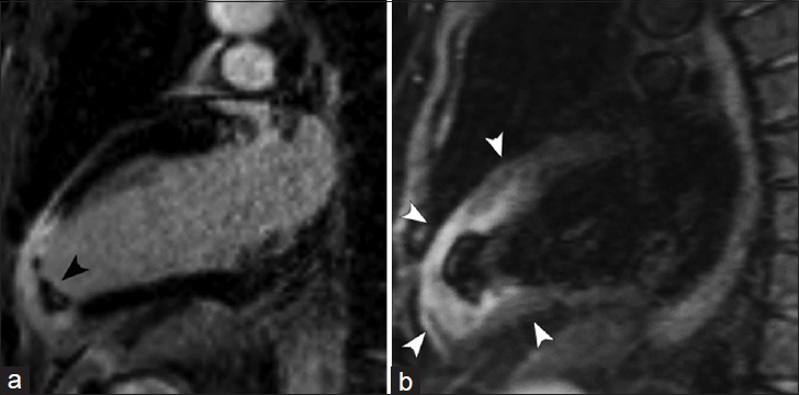 63-year-old male presenting with acute chest pain. CMRI two-chamber views. (a) DEIR imaging demonstrates a region of transmural LGE in the apex and apical anterior wall of the left ventricle with an intracavitary thrombus (black arrowhead). (b) T2-weighted Turbo Spin Echo shows increased signal intensity in the regions of abnormal LGE (white arrowheads), representing interstitial edema in the setting of acute myocardial infarction.