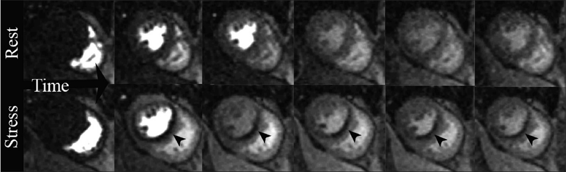 66-year-old male with situs inversus, presenting with orthopnea. Positive stress CMRI short-axis views. T1-weighted first-pass perfusion sequential imaging as a bolus of gadolinium contrast transits through the heart: Rest study demonstrates diffuse homogeneous contrast uptake in the myocardium. Stress study obtained two minutes after IV administration of the coronary vasodilator regadenoson, a perfusion defect is noted in the interventricular septum and inferior wall (arrowheads) along the left anterior descending (LAD) and RC vascular territories.