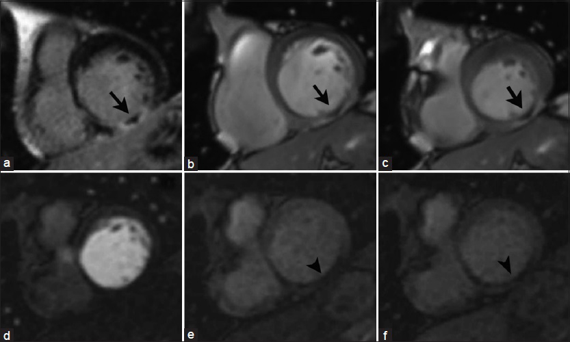 65-year-old male with history of previous myocardial infarction secondary to RC artery occlusion. Short-axis views at the level of the cardiac base: DEIR imaging (a) demonstrates a central core of low signal intensity surrounded by a zone of LGE (infarct) in the basal inferior wall of the LV (arrow). Cine SSFP imaging at end diastole (b) and end systole (c) shows focal LV akinesis matching the zone of abnormal enhancement. Serial T1-weighted first-pass perfusion imaging (d–f) reveals a perfusion_defect in the corresponding area (arrowheads), _ consistent with microvascular obstruction in a no-reflow zone.