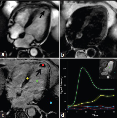64-year-old male with chest pain and an intracavitary mass found on echocardiography. CMRI long horizontal axis (four-chamber) views. SSFP (a) demonstrates an intracavitary mass in the apex of the left ventricle (arrow). T1-weighted imaging (b) shows the lesion appearing isointense to the myocardium. DEIR (c) shows lack of enhancement of the mass abutting an area of transmural LGE in the apex in the LAD artery distribution. Graphic representation of dynamic enhancement (d) demonstrates absence of contrast enhancement in the lesion core (red) when compared with the blood pool (green) and normal myocardium (yellow) consistent with a thrombus due to myocardial infarction.
