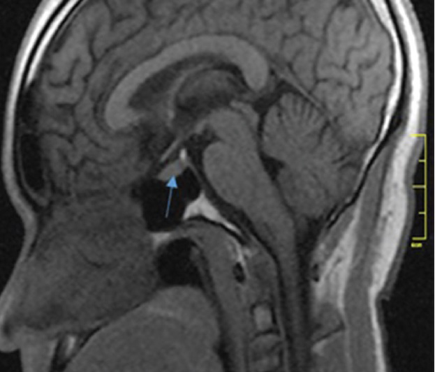 Magnetic Resonance Imaging Determination of Normal Pituitary Gland