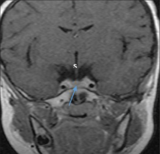 Magnetic Resonance Imaging Determination of Normal Pituitary Gland