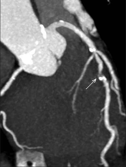 52-year-old male with atypical chest pain. Coronary computed tomography angiography curved planar reformation image of the mid left anterior descending coronary artery. The white arrow marks an area suspicious for significant stenosis (>70%).