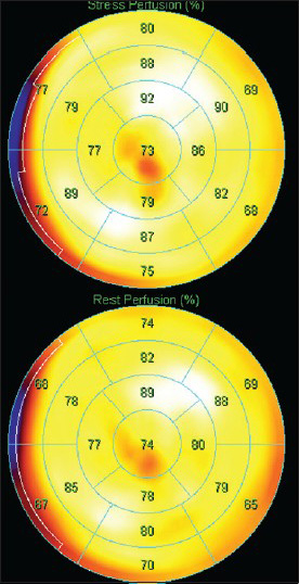 52-year-old male with atypical chest pain. Static rubidium-82 perfusion images (17 segment polar maps) demonstrates no difference between stress (top) and rest perfusion (bottom). Images were acquired 150 s after injection of 1110 MBq Rb82. Total acquisition time was 270 s.