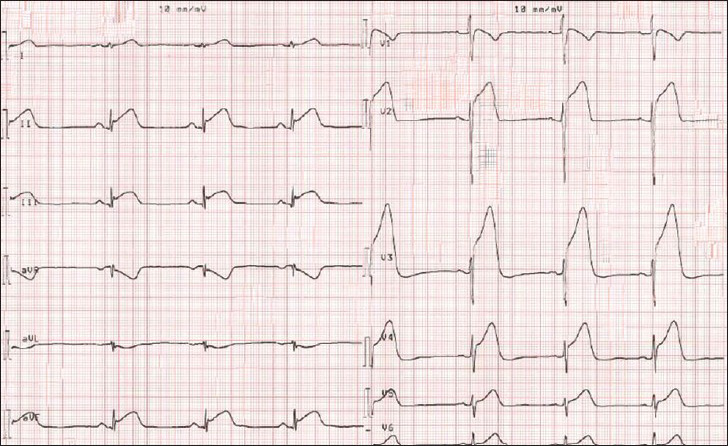 53-year-old male presenting with severe chest pain and cardiac arrest, which was successfully treated with resuscitation and cardioversion. 12-lead electrocardiogram shows massive ST-elevation consistent with anterior ST-elevation myocardial infarction.