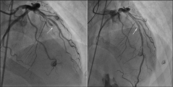 53-year-old male presenting with severe chest pain and cardiac arrest, which was successfully treated with resuscitation and cardioversion. Invasive angiography shows prestent image of left anterior descending coronary artery occlusion marked by the white arrow (left side, angiography projection: 4° right anterior oblique and 24° cranial) and poststent image of re-perfused left anterior descending coronary artery with the white arrow marking the point of previous occlusion (right side, angiography projection: 6° right anterior oblique and 30° cranial).