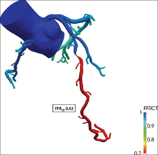 52-year-old male with atypical chest pain. Fractional flow reserve (FFRCT = 0.52) derived from coronary computed tomography images and based on a physiologic model of coronary blood flow using three principles: (1) The total resting coronary blood flow can be quantified relative to the myocardial mass, (2) The microcirculatory vascular resistance at rest is inversely proportional to the size of the supplying coronary arteries, and (3) The vasodilatory response of the coronary microcirculation to adenosine can be predicted, allowing computational modeling of maximal hyperemia. The integration of the physiological model into 3-dimensional computational models allows computation of coronary flow and pressure under hyperemic conditions.