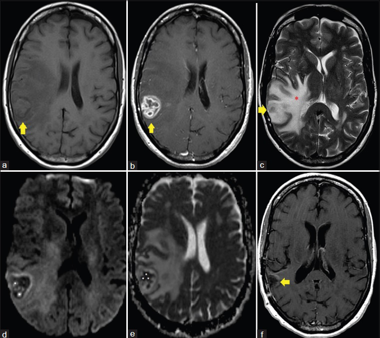 58-year-old Caucasian female presented with a 6-week history of dizziness upon standing and was diagnosed with cerebral blastomycosis. (a) Axial T1 image, pre-gadolinium administration, shows a 3.0 cm anteroposterior × 2.4 cm transverse × 3.1 cm craniocaudal lesion within the right temporoparietal region (yellow arrow). (b) Axial T1 image, post-gadolinium administration, shows a 3.0 cm anteroposterior × 2.4 cm transverse × 3.1 cm craniocaudal enhancing lesion within the right temporoparietal region (yellow arrow). (c) Axial T2 image demonstrates marked surrounding vasogenic edema throughout the right cerebral hemisphere (red *). (d) Axial diffusion-weighted image demonstrates multiple rounded foci of reduced diffusivity within the central aspect of the lesion (white *). (e) Axial apparent diffusion coefficient (ADC) map image demonstrates multiple rounded foci of reduced diffusivity within the central aspect of the lesion (white *). (f) Axial T1 image, post-gadolinium administration, following resection and antifungal treatment of the lesion demonstrates a resection cavity in the area of the previously seen enhancing lesion with no evidence of residual enhancing infection. The patient is asymptomatic 8 months post resection.