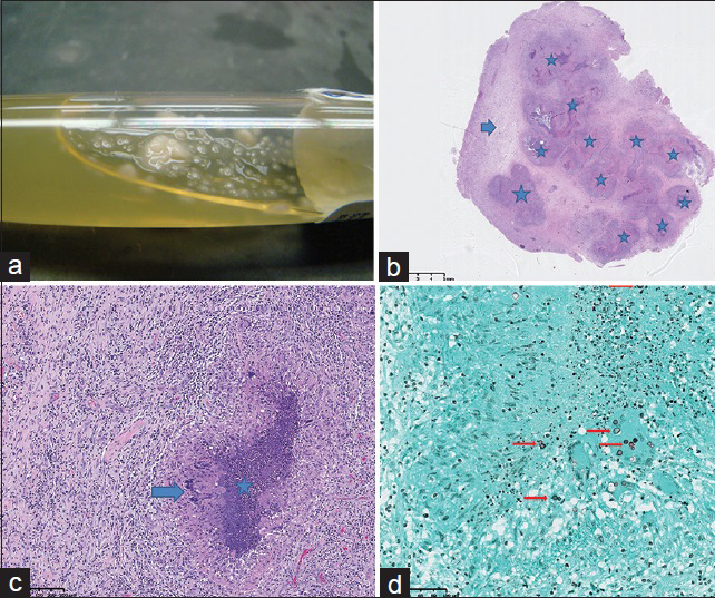 58-year-old Caucasian female presented with a 6-week history of dizziness upon standing and was diagnosed with cerebral blastomycosis. (a) Photograph of aspirated fluid from the parenchymal abscess demonstrates yeast formation (white droplets) within purulent fluid. (b) Photomicrograph of microscopic examination of the resected lesion: low-power view with 1.5 × magnification shows multiple necrotizing granulomas (stars) and a rim of reactive brain tissue (arrow). The granulomas correspond to areas of decreased signal seen on diffusion-weighted imaging. (c) Photomicrograph of microscopic examination of the resected lesion: high-power view of the granuloma with 40 × magnification shows a rim of palisading histiocytes (arrow) with central necrosis (star). d) Photomicrograph of microscopic examination of the resected lesion. stained with Grocott-methenamine silver (GMS) stain at 40× magnification, highlights the budding yeast of Blastomyces dermatitidis (arrows).