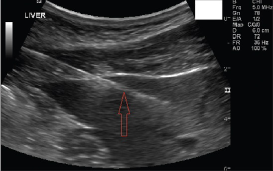 46-year-old asymptomatic man presented with elevated liver enzymes. Serological markers for other causes of elevated liver enzymes did not reveal any pathology. US-guided liver biopsy in the left lobe of the liver was performed. Gray-scale US longitudinal view shows the left lobe of liver with the needle in the parenchyma (seen as white echogenic line).