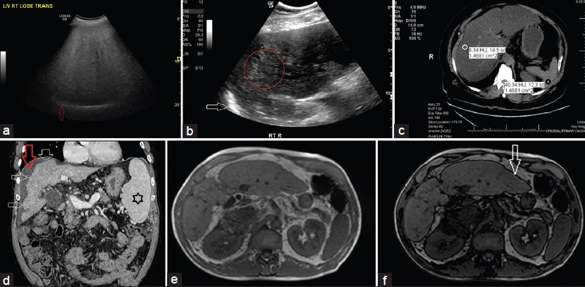 (a) 56-year-old man with metabolic syndrome and mildly elevated liver enzymes. Gray-scale US transverse view through the right lobe of liver shows the following: 1. Hyperechogenic liver tissue with fine, tightly packed echoes on US examination (the so-called “bright liver”), characteristic of liver steatosis; 2. Decreased sonographic visualization of portal and hepatic veins giving rise to a “featureless or bland appearance;” and 3. Decreased ability of the US beam to penetrate the liver tissue causing posterior darkness and loss of definition of the diaphragm (posterior beam attenuation) (red arrow). (b) 68-year-old woman with metabolic syndrome. Gray-scale US longitudinal view of right lobe of liver shows the following: 1. Coarse echo pattern (within the red circle), different from fine, packed echoes of steatosis; 2. Lack of posterior beam attenuation with definite visualization of diaphragm (white arrow); 3. Fibrosis with steatosis seen as coarse echoes (“pin-head echoes”) within the fine echo pattern of steatosis (differentiation is difficult as fibrosis and steatosis have similar sonographic appearance, “fatty-fibrotic pattern”); and 4. Later there was volume loss, nodular contour, and ascites. (c) 48-year-old asymptomatic man with mildly elevated liver enzymes. Unenhanced CT scan, axial section of the liver shows HUliver 8 (white circle) and HUspleen 40 (black circle), CTL-S of −32, and hepatic attenuation index (HAI) of 0.2. Fatty infiltration is diagnosed when the criteria of HUliver <48 HU, CTL-S of −2, and HAI of 0.8 are met. (d) 53-year-old man previously diagnosed as NASH presented with US features of cirrhosis. Contrast-enhanced triple-phase CT was performed to evaluate for portal hypertension and hepatocellular carcinoma. Contrast-enhanced CT-venous phase, coronal images reveals a cirrhotic liver as evidenced by the characteristic features of right lobe atrophy, nodular surface (multiple white arrows), spenomegaly (black star), and ascites (red arrow). (e and f) 51-year-old woman with an ovarian cyst presented for evaluation by MRI. Abdomen and pelvic MRI was performed. (e) In-phase T1-weighted gradient-echo images of areas with a significant amount of intracellular fat shows the liver to be brighter in signal intensity than the spleen and paraspinal muscles. (f) Out-of-phase images shows lower signal intensity of liver than on the corresponding in-phase images. Characteristically, out-of-phase images are identified by a thick black rim at fat–water boundaries, an artifact that has been termed the “India ink effect” or “boundary artifact” (white arrow).