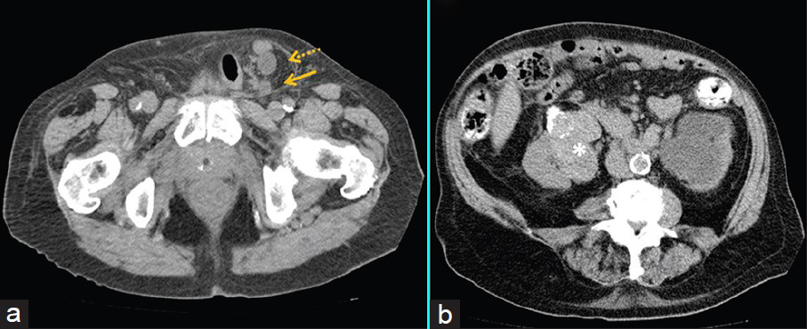 84-year-old man with acute deterioration of renal function in setting of known chronic renal failure diagnosed with obstructive uropathy secondary to uretero-inguinal hernia. (a) Axial image of a non-contrast computed tomography (CT) scan of the abdomen demonstrates the left ureter entering (dashed arrow) and exiting (solid arrow) a left indirect inguinal hernia with a hydronephrotic left kidney. (b) Axial image of a non-contrast CT scan of the abdomen shows a heterogeneous, calcified solid right renal mass (asterisk), diagnosed as a papillary renal cell carcinoma.