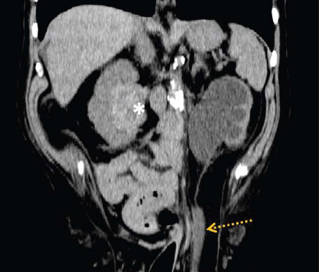 84-year-old man with acute deterioration of renal function in setting of known chronic renal failure diagnosed with obstructive uropathy secondary to uretero-inguinal hernia. Coronal image of a non-contrast CT scan of the abdomen demonstrates the left ureter entering a left indirect inguinal hernia (dashed arrow) and a calcified solid renal mass on the contralateral kidney (asterisk).