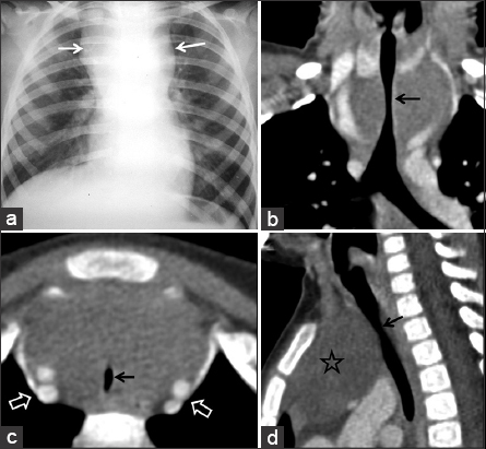 3-year-old female with noisy breathing and exertional dyspnoea with suspected mediastinal mass. (a) Plain radiograph shows mediastinal widening (white arrows) with relative narrowing at cardiac pedicle. (b) Coronal CT image shows tracheal narrowing by the homogeneous mass (black arrow). (c) Axial CT image demonstrates slit-like configuration of trachea (black arrow) due to compression. Blood vessels are widely separated (open arrows). (d) Sagittal CT image shows homogeneous anterior mediastinal mass (star) and relative narrowing of trachea (black arrow).