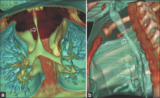 3-year-old female with noisy breathing and exertional dyspnoea with suspected mediastinal mass. (a and b) 3D rendered images show narrowing of the trachea (arrows).