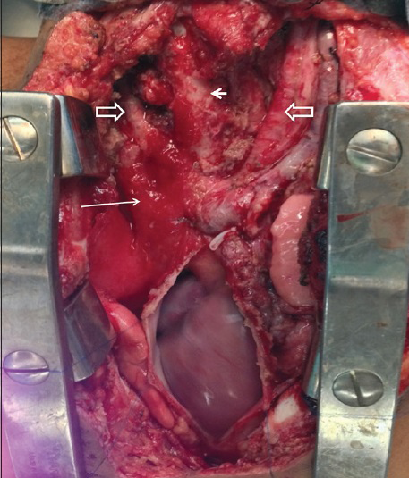 3-year-old female with noisy breathing and exertional dyspnoea with suspected mediastinal mass. Surgical bed after resection of the mass reveals superior vena cava, innominate vein (long arrow), great arteries (open arrows) and trachea (short arrow).