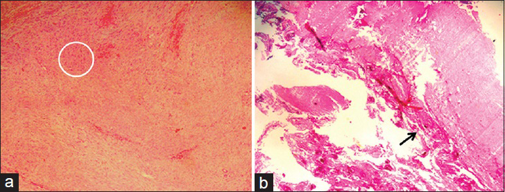 3-year-old female with noisy breathing and exertional dyspnoea with suspected mediastinal mass. Histological examination of the specimen; Photomicrograph with the hematoxylin and eosin stained tissue (a) at magnification of ×100 shows hypocellular tumor (circle) consisting of bland spindle cells, (b) at magnification of ×20 shows tumor adherent to thymic tissue (black arrow).