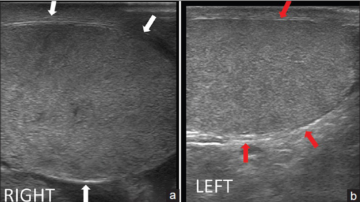 18-year-old man presented to emergency room with acute right testicular pain diagnosed as caused by a fibrous constricting band around the spermatic cord. (a and b) Gray scale longitudinal ultrasound of the right testis show a enlarged, hypoechoic, edematous right testis (between white arrows), and a normal left testis (between red arrows).