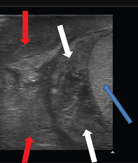 18-year-old man presented to emergency room with acute right testicular pain diagnosed as caused by a constricting fibrous band around the spermatic cord. Gray scale ultrasound longitudinal view demonstrates right testis (blue arrow), enlarged right epididymis (white arrows) and spermatic cord (red arrows).