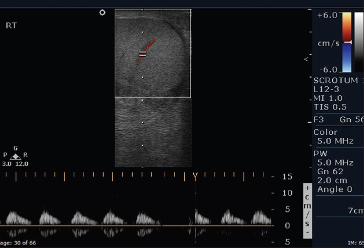 18-year-old man presented to emergency room with acute right testicular pain diagnosed as caused by a constricting fibrous band around the spermatic cord. Color flow spectral Doppler of the right testis demonstrates dampened arterial waveform with decreased diastolic blood flow.