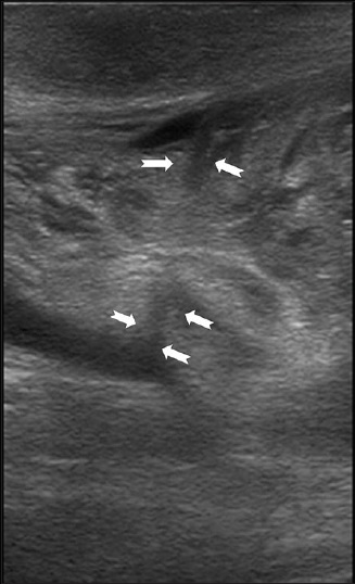 18-year-old man presented to emergency room with acute right testicular pain diagnosed as caused by a constricting fibrous band around the spermatic cord. Gray-scale ultrasound of the right hemiscrotum demonstrates a hypoechoic band like structure constricting the distal spermatic cord (between white arrows).