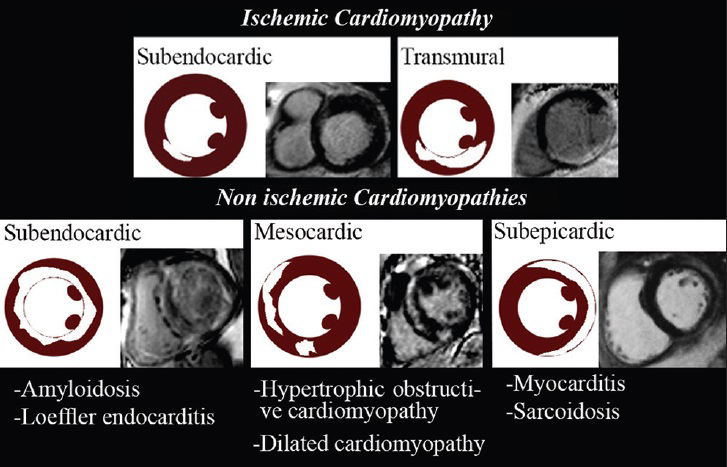 LGE patterns of ischemic and non-ischemic cardiomyopathies.