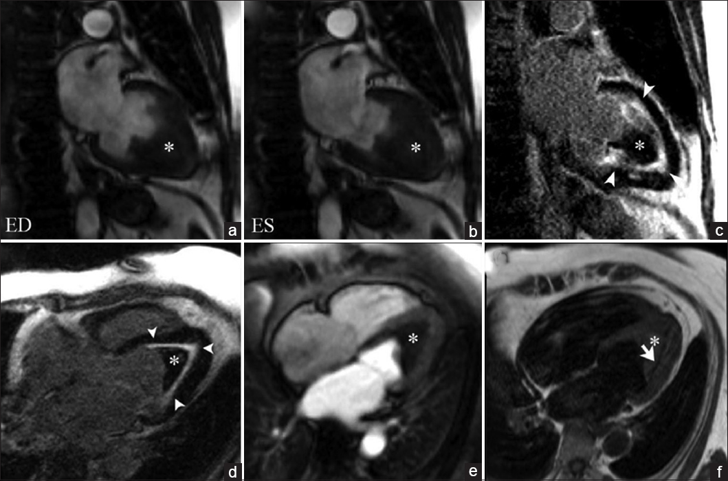 45-year-old female with rapidly progressive congestive heart failure, diagnosed with Loeffler endocarditis. Steady-state free precession (SSFP) cine image (a and b) demonstrate an endocavitary filling defect in the apex of the left ventricle (asterisks). (c and d) Delayed enhancement inversion recovery (DEIR) images demonstrate a thin area of intense linear delayed enhancement (arrowheads) distributed along the apical endocardium of the left ventricle, subtending the distribution of the filling defect. (e) First-pass perfusion image shows a lack of gadolinium uptake consistent with a thrombus (asterisk). (f) T1-weighted Turbo Spin Echo (TSE) imaging shows the region of endocardial enhancement is markedly hypointense (white arrow), indicating dense subendocardial fibrosis. Note that the remainder of the myocardium deep to the subendocardial fibrosis shows normal signal intensity and perfusion. ED = End diastole, ES = End systole.