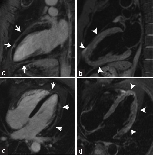 43-year-old male with chest pain, diagnosed with post-streptococcal myocarditis. DEIR imaging with two chamber (a) and four chamber (c) views demonstrate patchy areas of myocardial enhancement following a subepicardial distribution (arrows) indicative of inflammatory tissue damage. T2-weighted black-blood images (b and d) demonstrate myocardial edema matching the regions of abnormal enhancement (arrowheads).