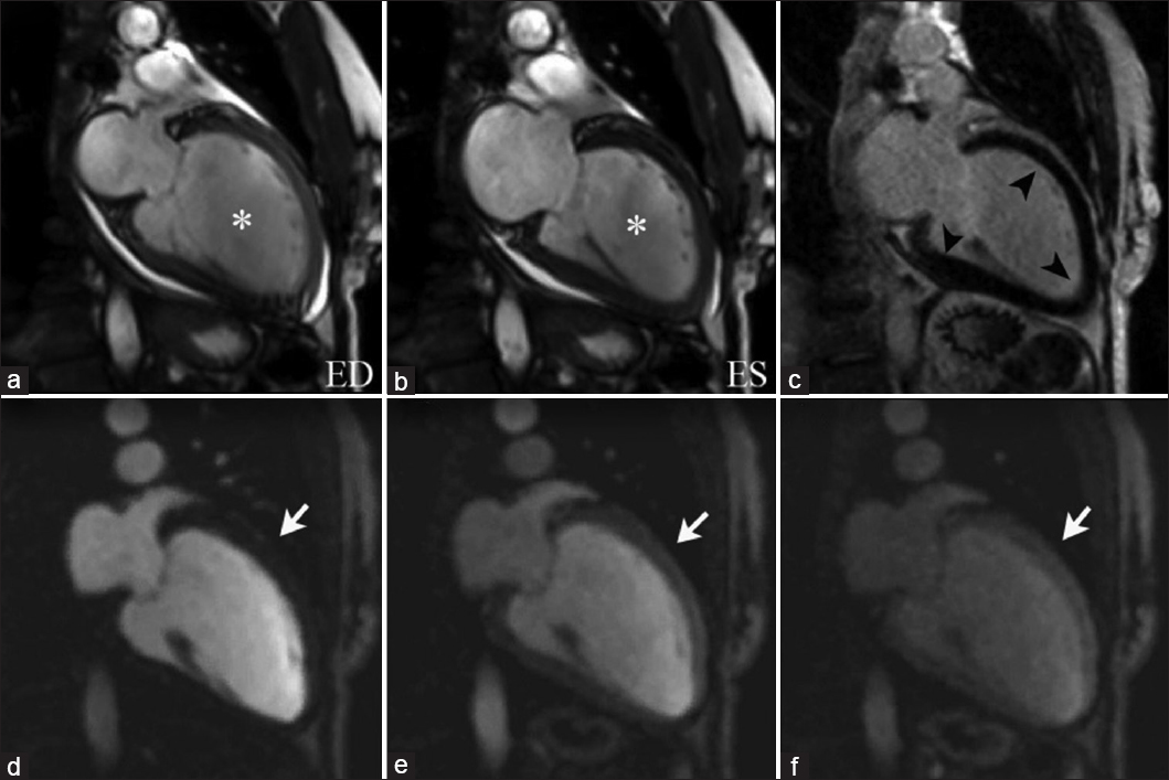 72-year-old female with symptoms of congestive heart failure, diagnosed with dilated cardiomyopathy. SSFP imaging with two-chamber views at end diastole(a) and end systole (b) illustrate left ventricular dilation and global hypokinesis (asterisks). DEIR imaging (c) shows a fully viable myocardium without abnormal enhancement (arrowheads). Sequential imaging of first-pass perfusion (d–f) demonstrates no perfusion defects (arrows). These findings are consistent with non-ischemic dilated cardiomyopathy.