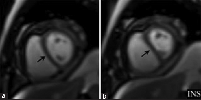 Cardiac MRI short-axis view single-shot SSFP free breathing imaging demonstrates paradoxical movement of the interventricular septum accentuated during inspiration (arrows). INS = inspiration.