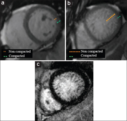Comparison of (a) normal myocardial compaction of an asymptomatic 58-year-old female with (b and c) a 53-year-old female with progressive dyspnea diagnosed with myocardial non-compaction. (b) SSFP imaging demonstrates a diffusely thickened and hypertrabeculated non-compacted layer of the myocardium at the left mid-ventricle, more accentuated in the lateral wall. (c) As illustrated by DEIR, no abnormal areas of hyperenhancement are seen.
