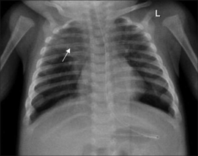 4-month-old infant with cough and expectoration, diagnosed with DiGeorge syndrome. Frontal radiograph shows consolidation involving the right upper zone (arrow).