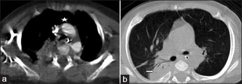 4-month-old infant with cough and expectoration, diagnosed with DiGeorge syndrome. (a) Contrast-enhanced axial image of CT chest in mediastinal window shows absent thymus (asterisk). (b) Non-contrast axial image of CT chest in lung window shows consolidation involving the right upper lobe (right arrow).