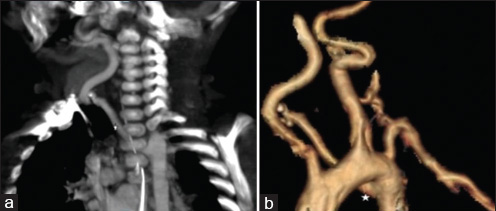 4-month-old infant with cough and expectoration, diagnosed with DiGeorge syndrome. (a) CT scan-coronal maximum intensity projection (MIP) in arterial phase of chest shows aberrant right subclavian artery (asterisk). (b) CT scan volume-rendered image shows aberrant right subclavian artery (asterisk).