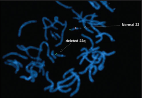 4-month-old infant with cough and expectoration, diagnosed with DiGeorge syndrome. Fluorescent in situ hybridization (FISH) study shows deletion of chromosome 22q11.2 (arrow)